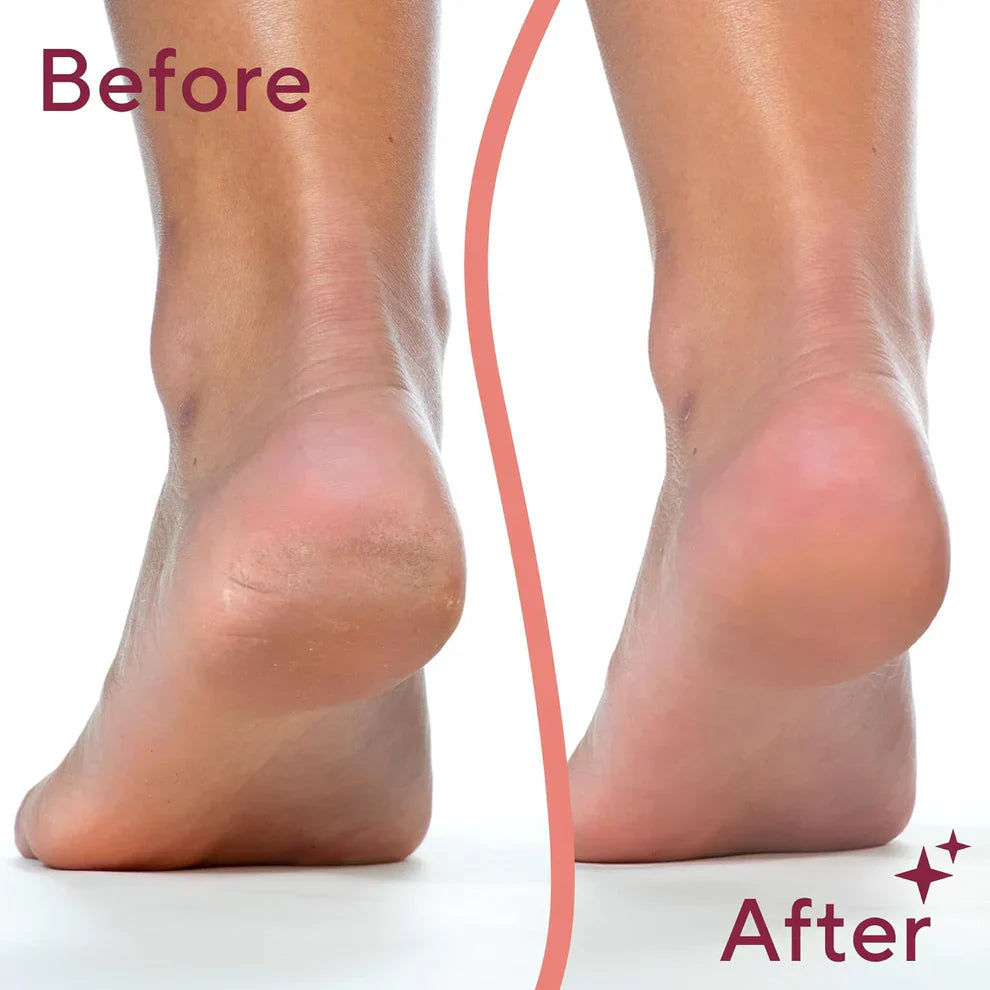 Rechargeable Electric Foot Callus Remover